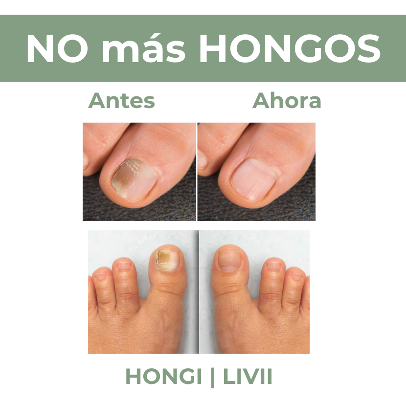 Gotas para Hongos de Uñas y Pies - Hongi Amorolfina 30 ml